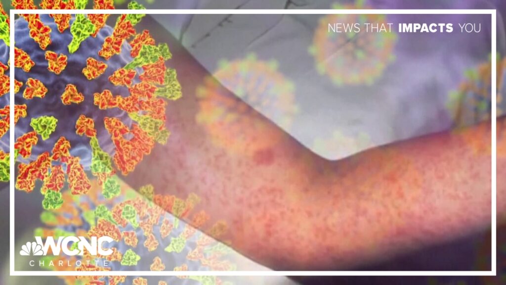 Measles Cases in South Carolina Surge to 310